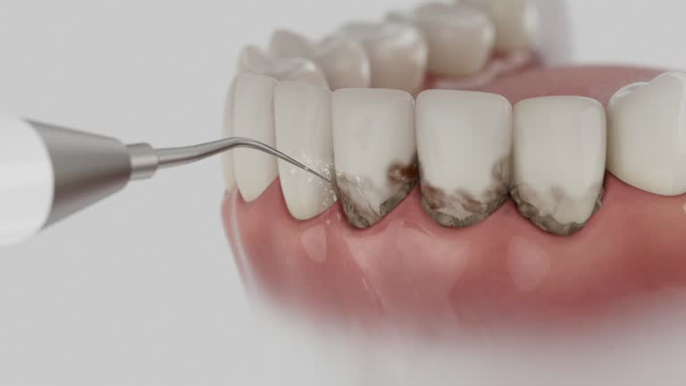 Trusted Invisalign Clear Aligners service in San Francisco, CA - Dentist Open Now